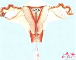 上海借卵子怀孕几率大吗，孕妇晚上孕吐严重怎么办？适量运动合理饮食